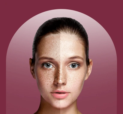 Melasma Treatment in Delhi (1)