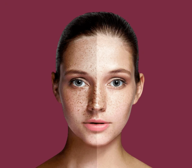 Melasma Treatment in Delhi