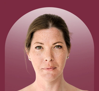 Pigmentation Treatment in Vasant Kunj