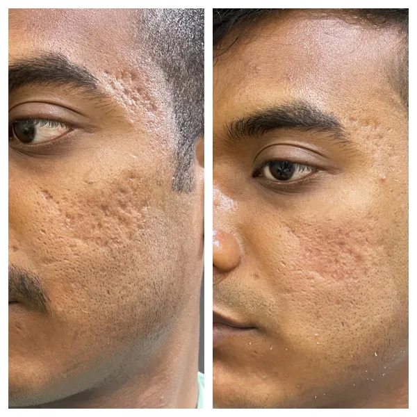 Acne Scar 2-B