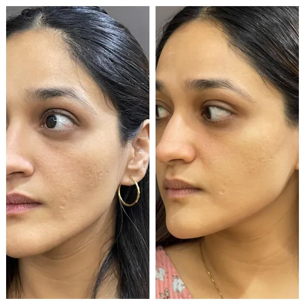 Acne Scar filler injection