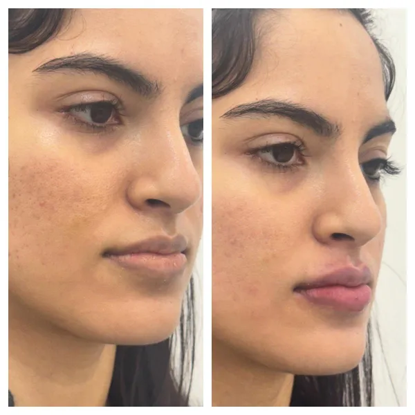 Acne scar skin booster and lip filler