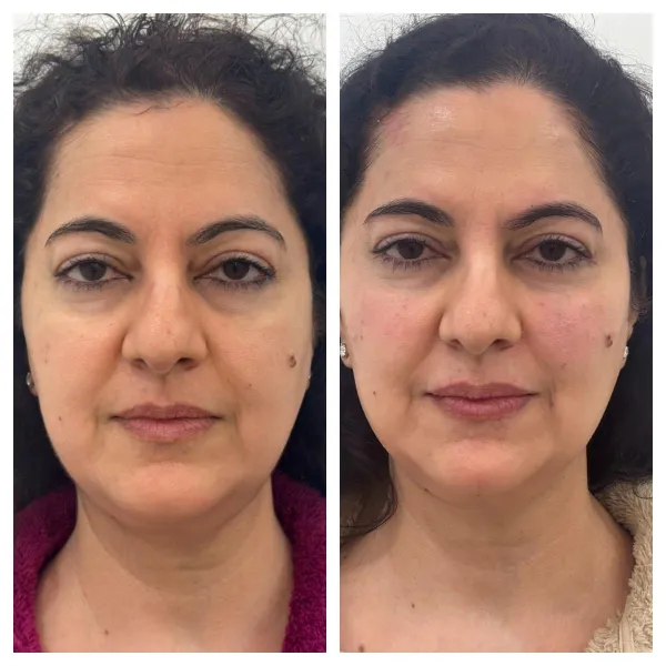 Filler Midface and chin