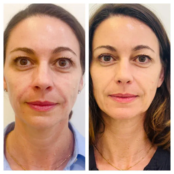 Filler injection mud cheek area