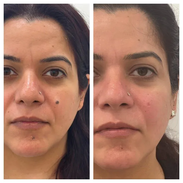 Mole excision co2 laser 2