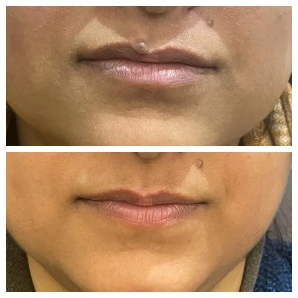 Mole removal upper lip