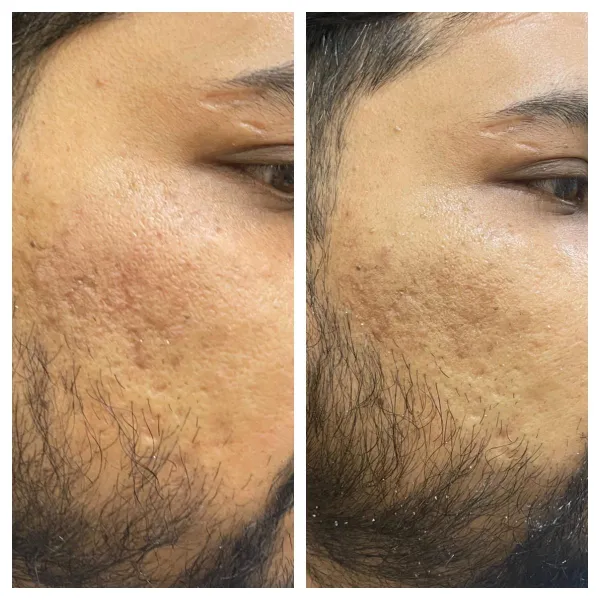 Scar _ MNRF + CO2 + subcision